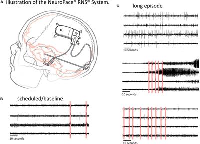 A High Accuracy Electrographic Seizure Classifier Trained Using Semi-Supervised Labeling Applied to a Large Spectrogram Dataset